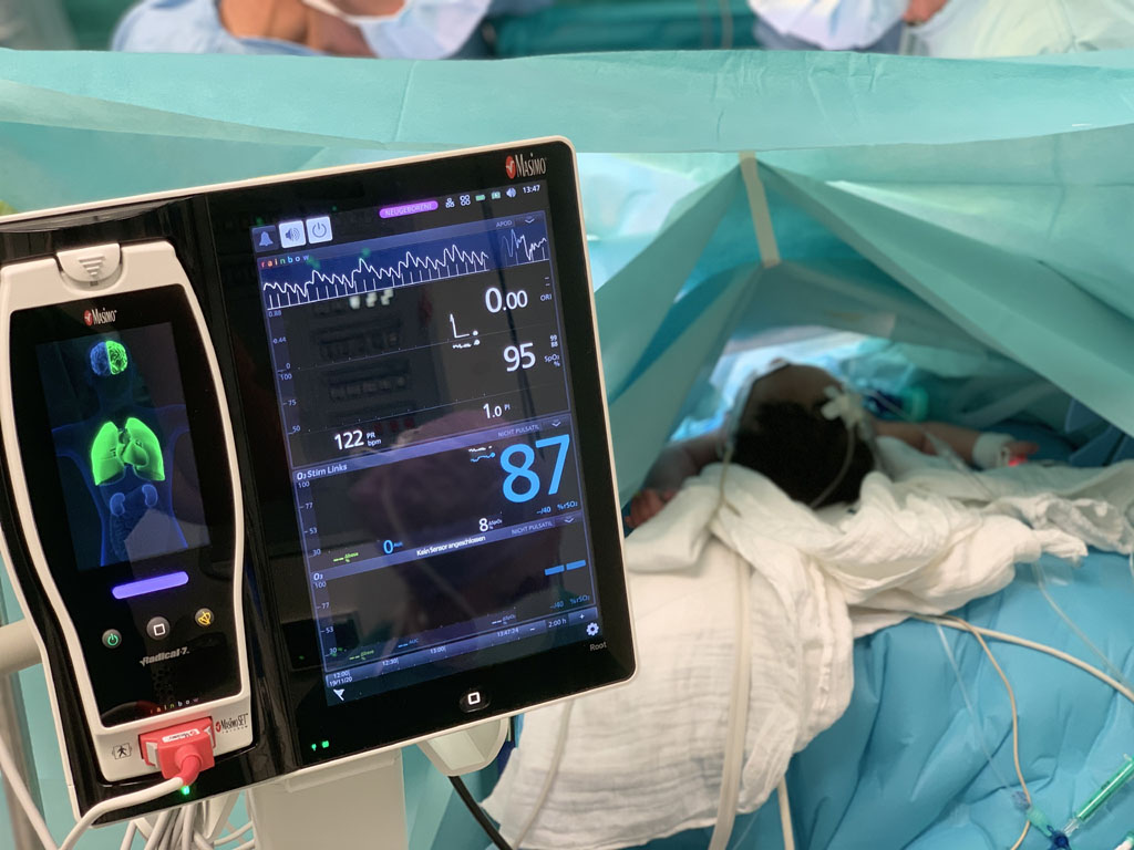 Oxygen Reserve Index ORI